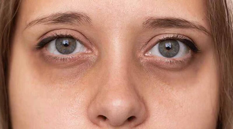 स्ट्रेस, खराब डाइट और नींद की कमी के कारण होते है डार्क सर्कल्स, ऐसे करें दूर