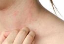 गर्मियों में स्‍कि‍न रेडनेस की समस्‍या आम है, ट्राई करें ये ट‍िप्‍स
