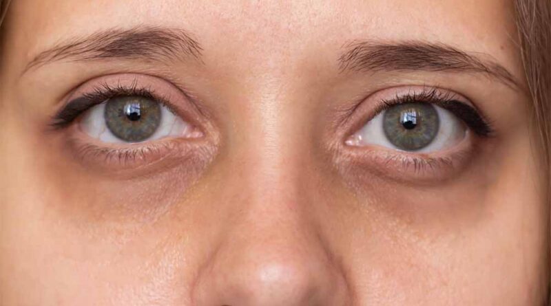 आंखों के नीचे के काले घेरे इस नुस्खे से हो जाएंगे छूमंतर