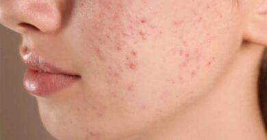 मानसून में मुंहासों की समस्या से हैं परेशान, यह रहा हल