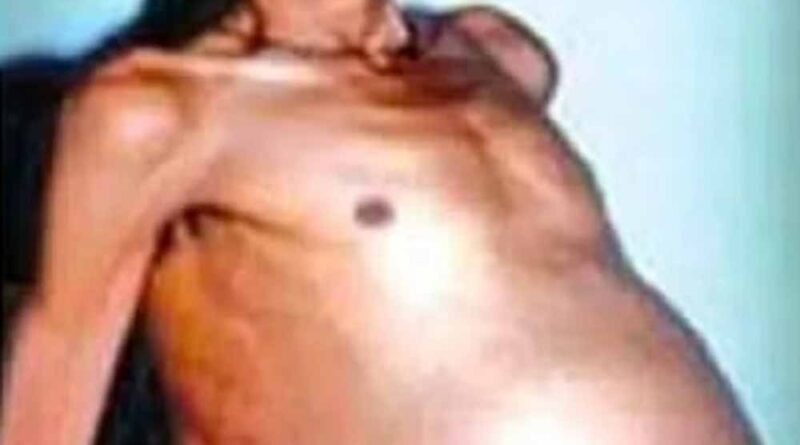 36 साल तक पेट में छिपे रहे जुड़वा भ्रूण, डॉक्टर भी रह गए हैरान