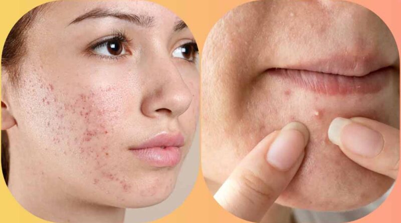 मुहांसे हटाने का ये उपाय पड़ सकता है भारी, चेहरे को पहुंचा सकता है नुकसान