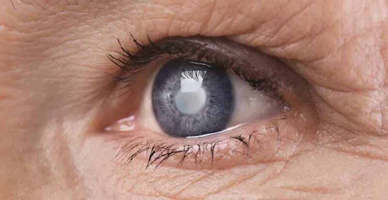 मुश्किल नहीं है मोतियाबिंद का इलाज