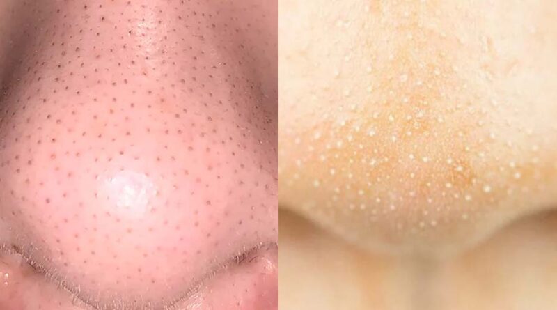 ब्लैकहेड्स बनाम व्हाइटहेड्स: क्या है फर्क और कैसे करें इलाज?