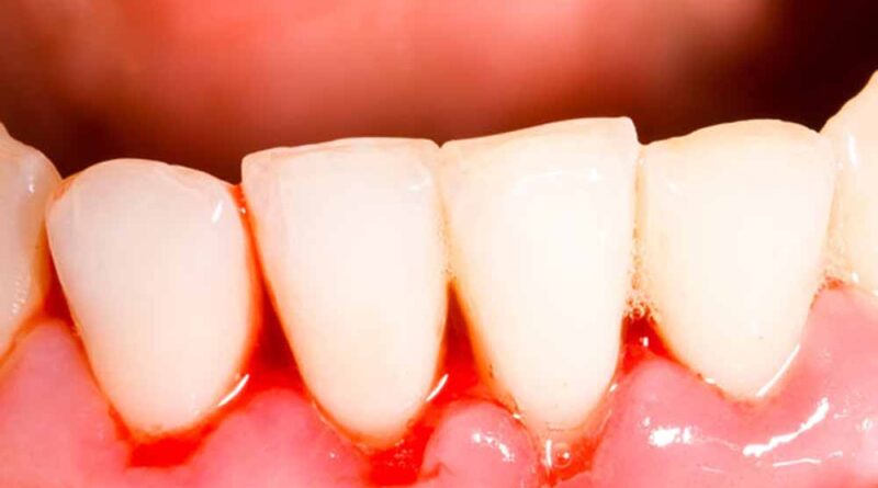 ब्रश करते समय मसूड़ों से खून आ रहा है? जानें कारण और आसान घरेलू उपाय